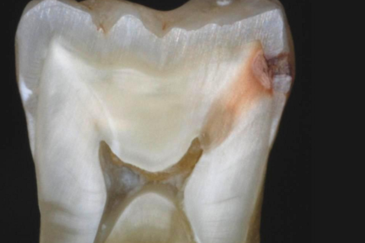 tooth cross-section: stages of cavity decay