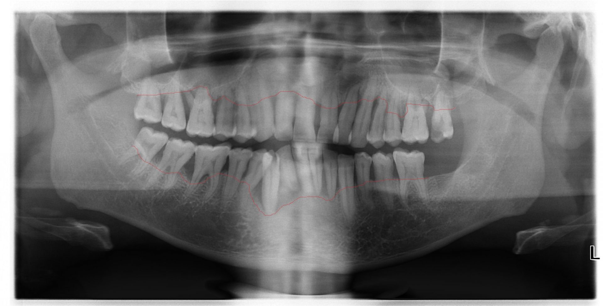 severe periodontitis panorex with marked bone level