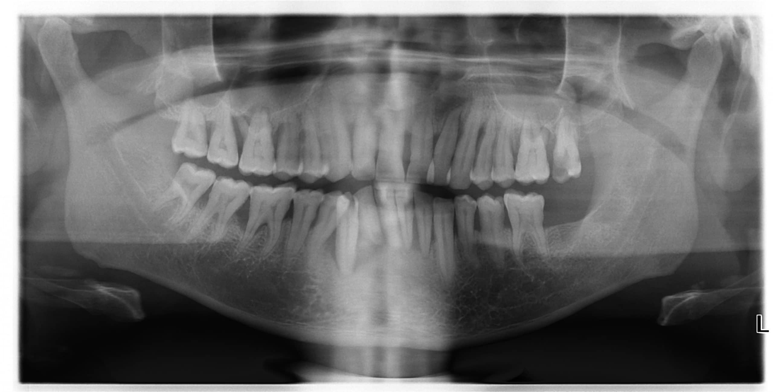 severe periodontitis panorex
