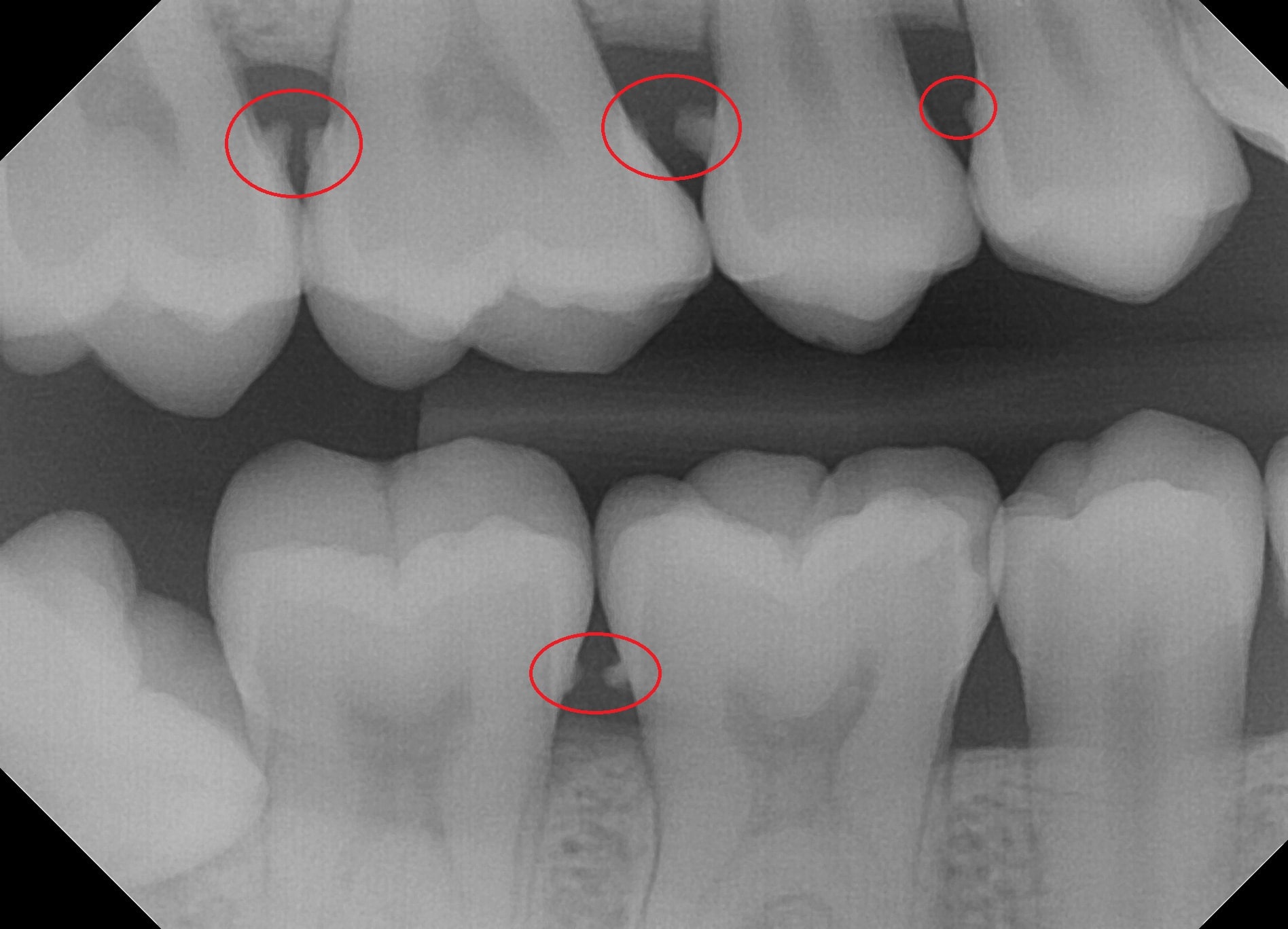 heavy radiographic calculus circled on bitewing