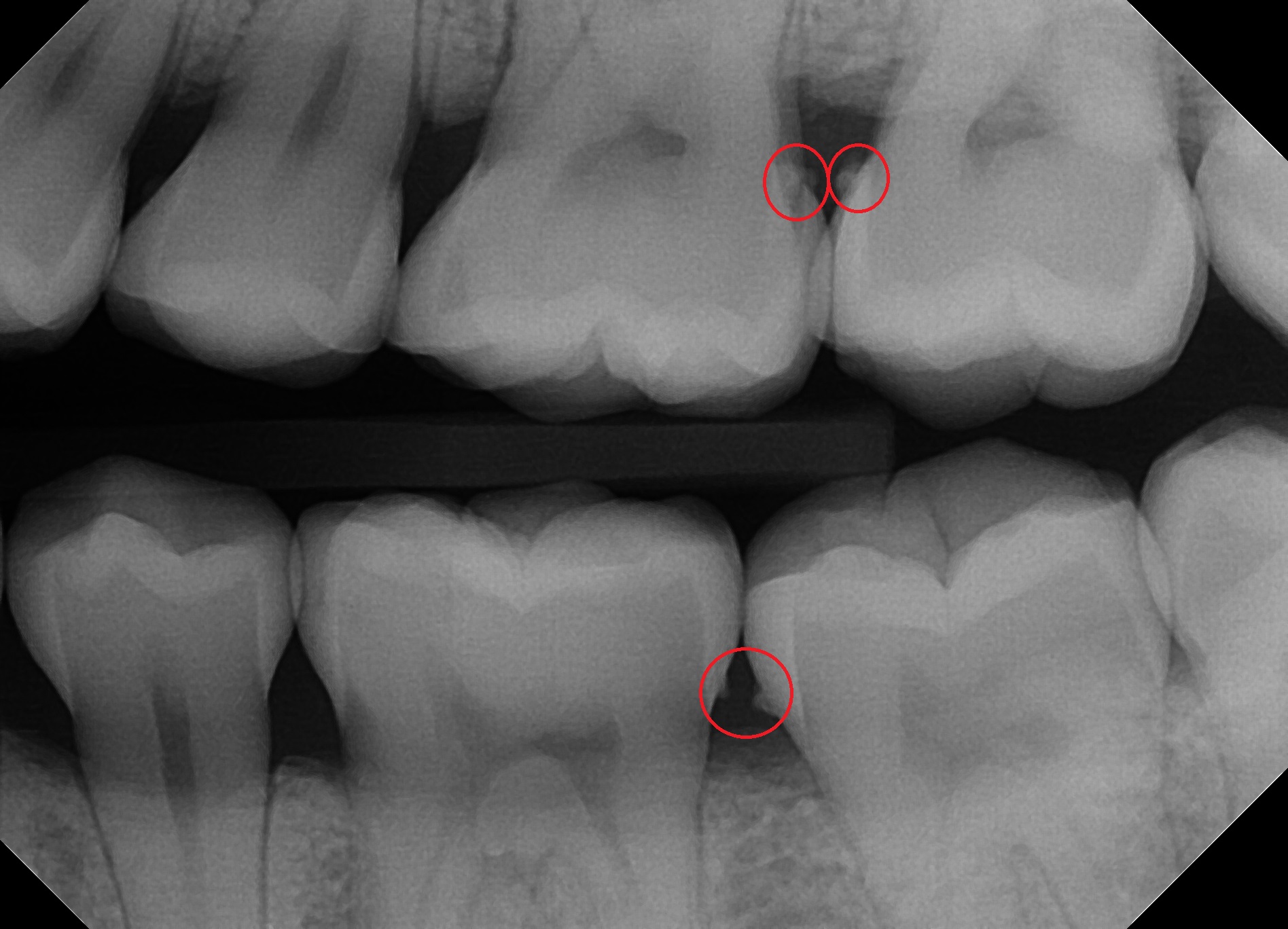 radiographic calculus circled on bitewing