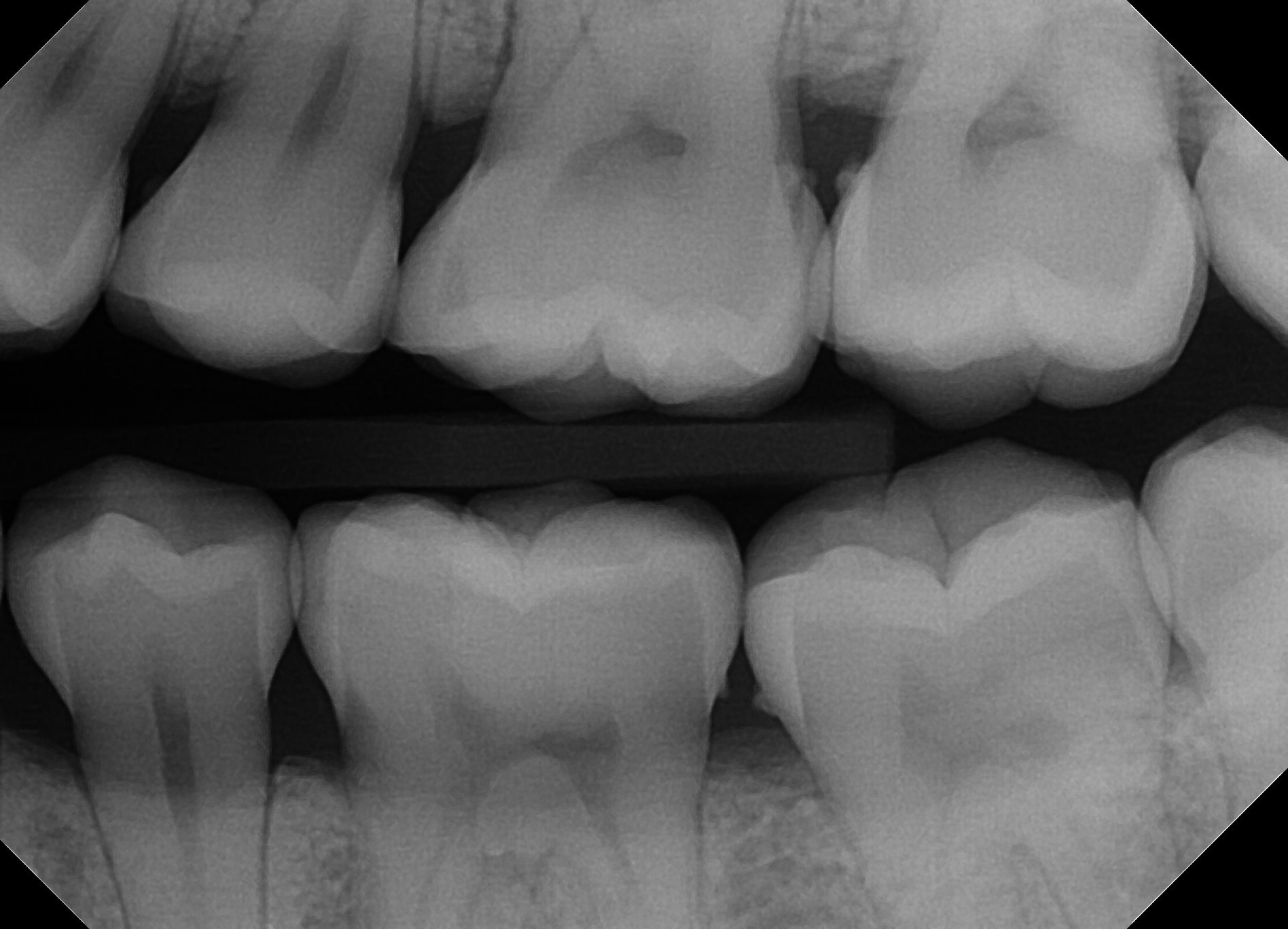 radiographic calculus on bitewing