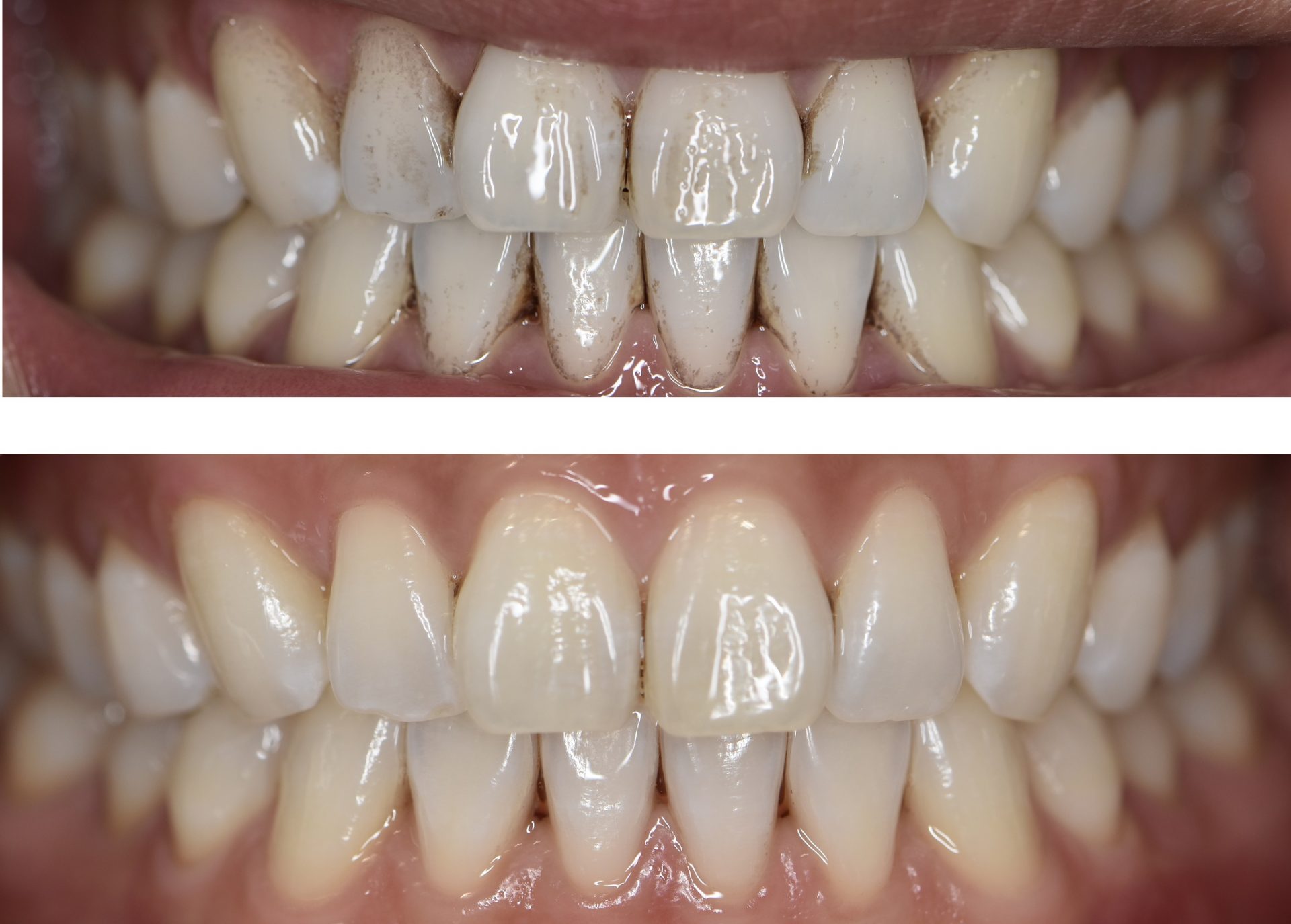 prophylactic regular dental cleaning