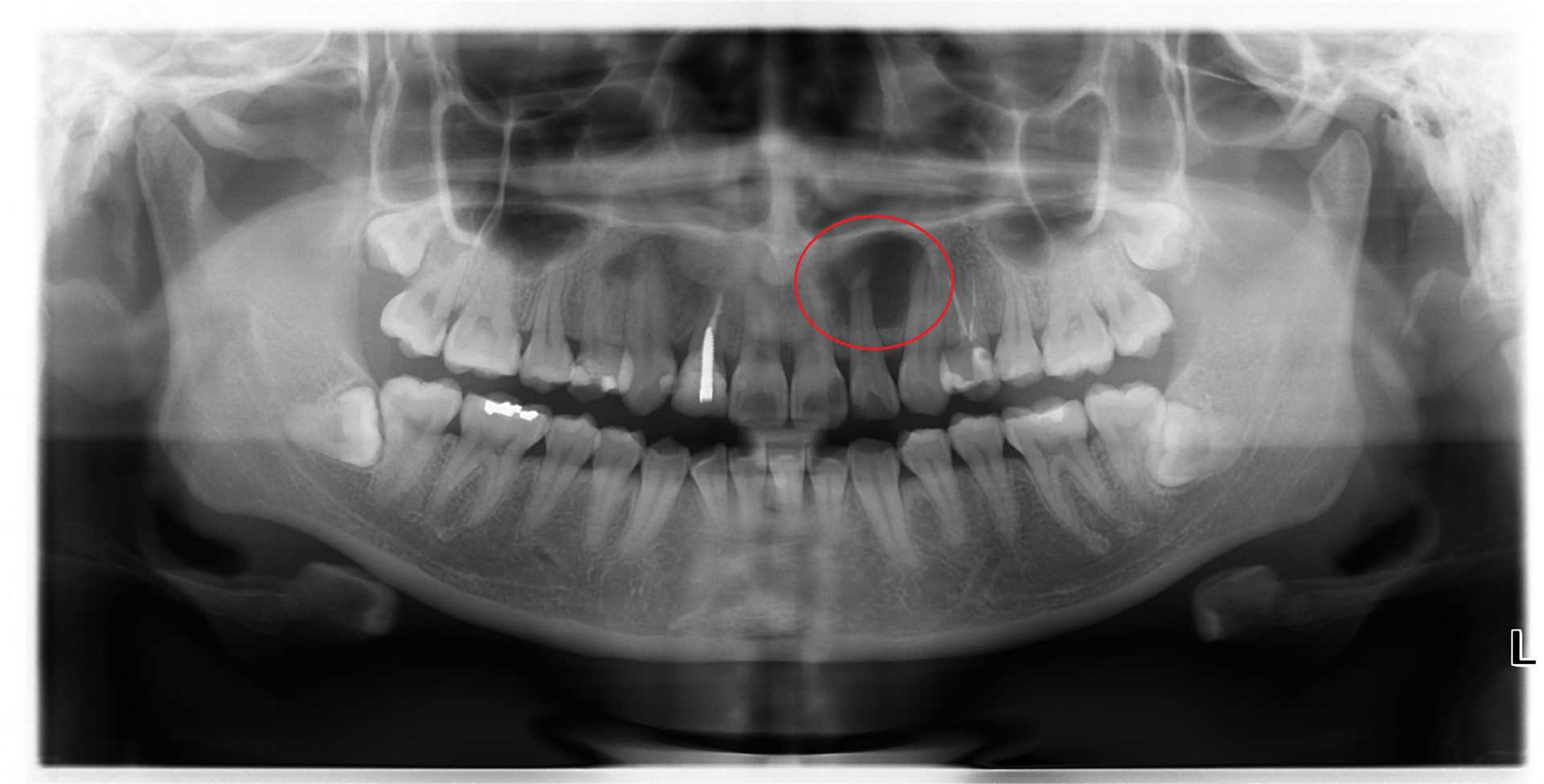 If I don't get a root canal, what could happen? - Smile Corners